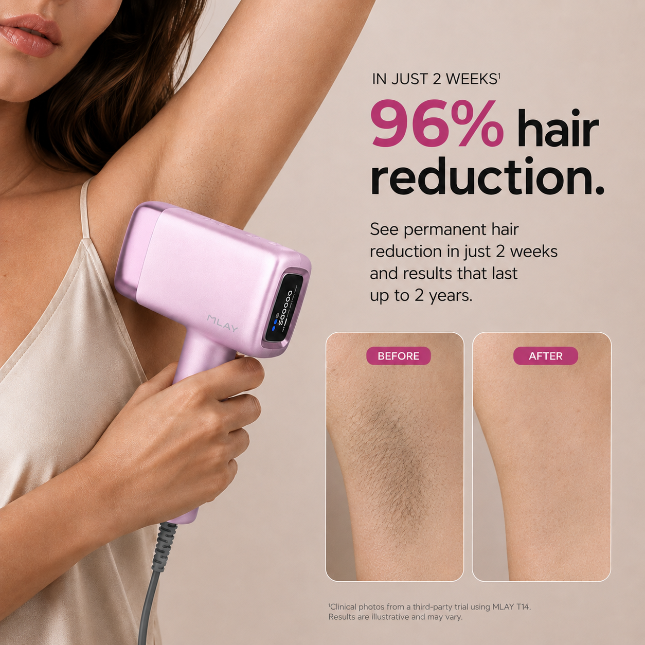 T14A Ice Cooling-High Energy Replaceable-Head IPL Device