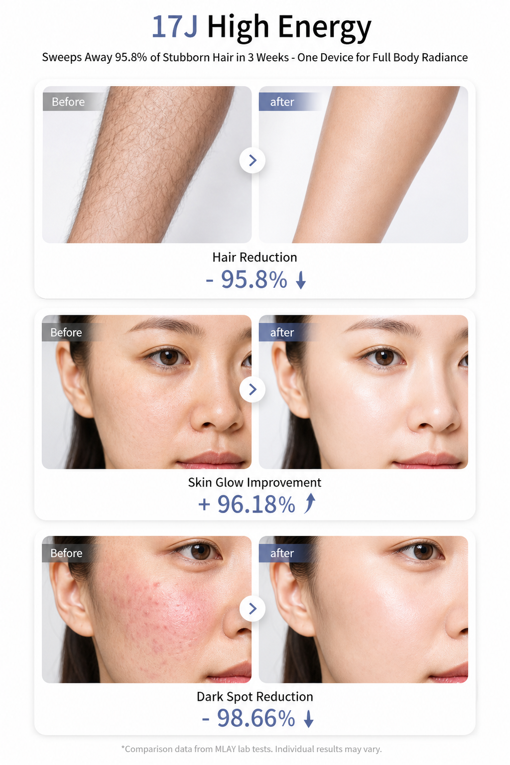MLAY T14 Ice Cooling IPL Hair Removal Device | 17J High Energy, Painless At-Home Hair Remover